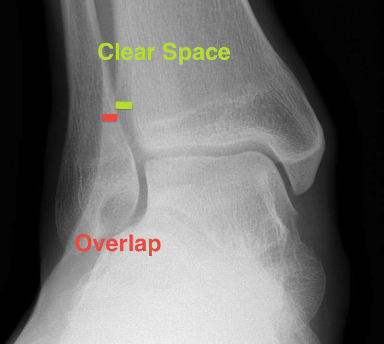 Ankle Mortice Xray Syndesmotic Measurements